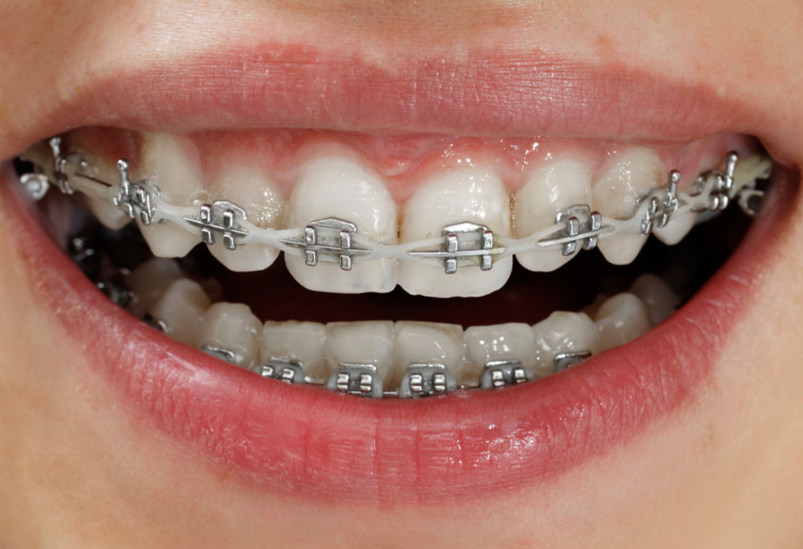 Do’s and Don’ts for Living with Braces