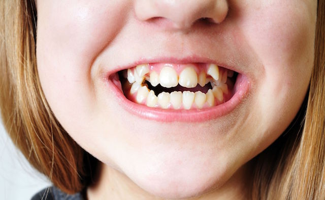 Crooked Teeth Could Lead to Greater Health Problems