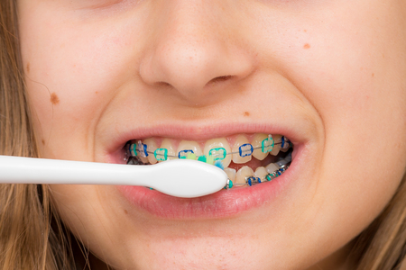 How to Avoid Staining Your Teeth While Wearing Braces