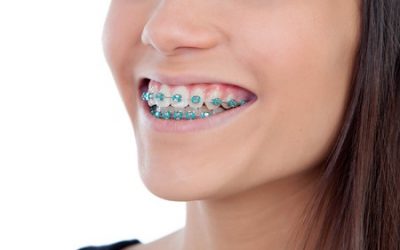 Invisalign vs. Braces