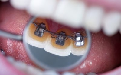 All About Lingual Braces