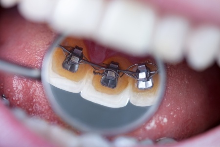 All About Lingual Braces