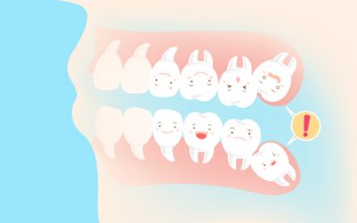 All you need to know about Wisdom Teeth