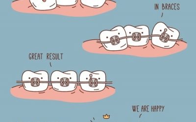 Health Benefits of Braces