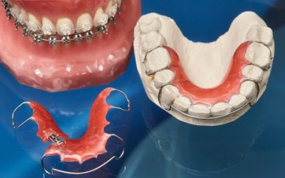 Braces and Retainers