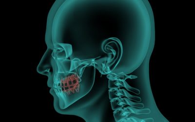 Jaw Surgery (Orthognathic Surgery)