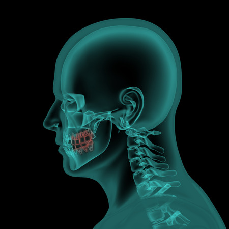 Jaw Surgery (Orthognathic Surgery)