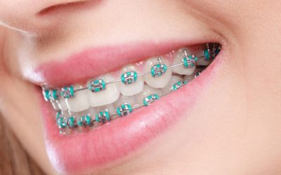 What to do in Case of an Orthodontic Emergency?