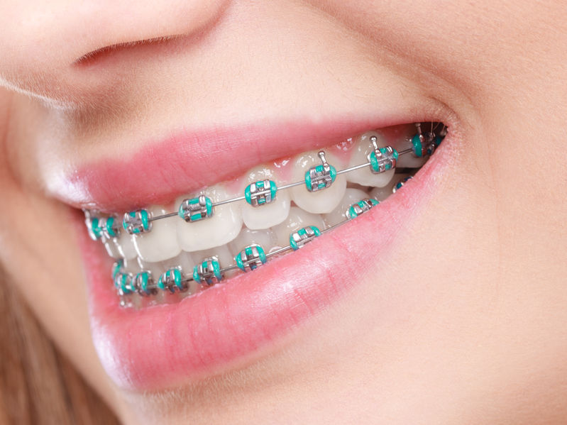 What to do in Case of an Orthodontic Emergency?