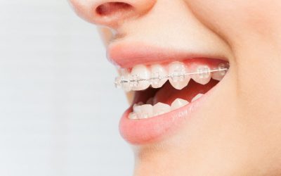 All You Need to Know About Damon Braces