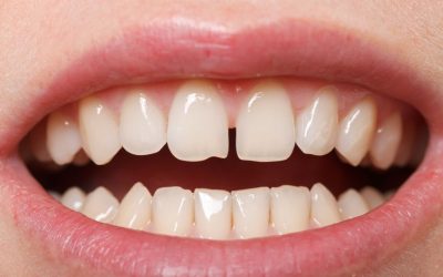 All you Need to know about Diastema