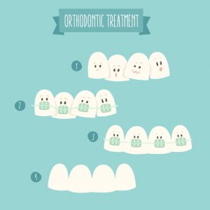 Getting Your Braces Off? Ask These Questions