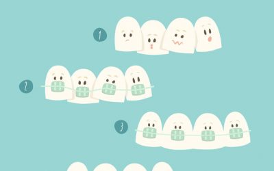 Getting Your Braces Off? Ask These Questions