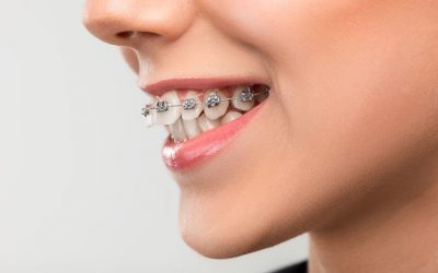 Can Correcting an Overbite be Beneficial?