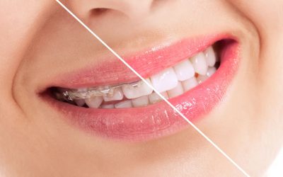 Things To Notice When Your Braces Come Off