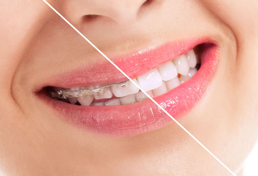 Things To Notice When Your Braces Come Off