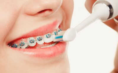 Brushing Tips for Patients with Braces