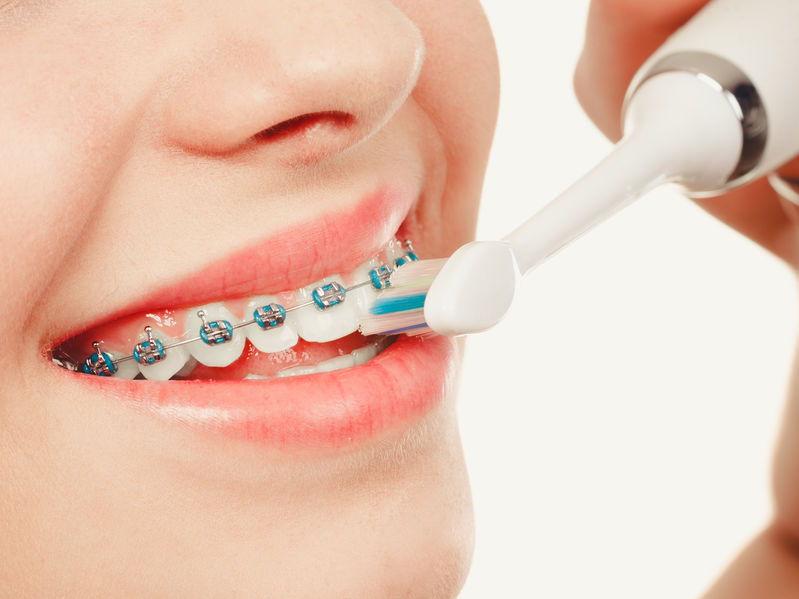 Brushing Tips for Patients with Braces