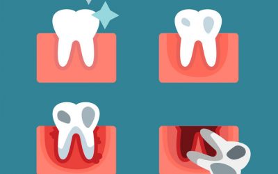 Gum Disease and Your Overall Health